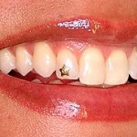 Brillantino sul dente - Dental piercing - Studio Dentistico Paolo